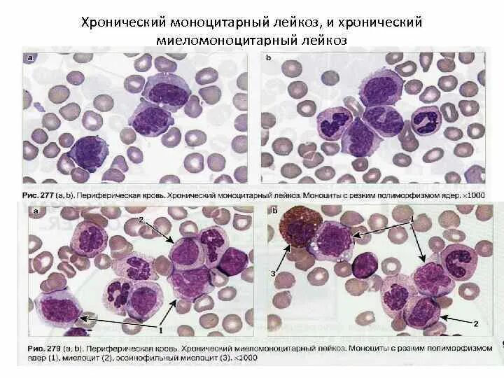 Цитологическое исследование пунктата. Острый миелобластный лейкоз картина крови. Острый и хронический миелобластный лейкоз. Хронический миелобластный лейкоз гистология. Хронический миеломоноцитарный лейкоз гистология.