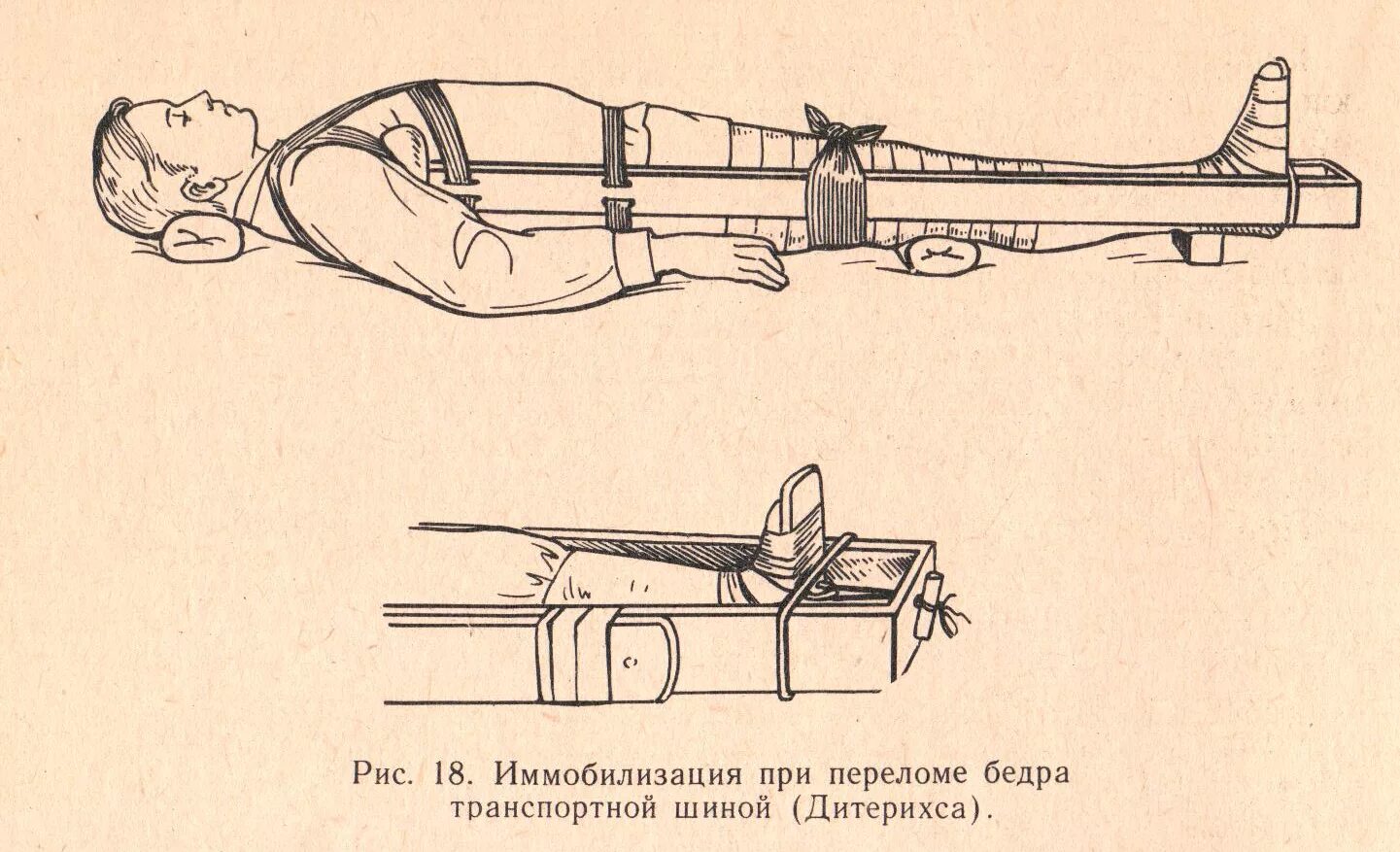 Открытый перелом бедра первая помощь. Иммобилизация шиной Дитерихса. Перелом бедренной кости шина Дитерихса. Перелом бедра шина Крамера. Шина Дитерихса при переломе бедра.