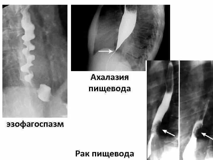 Диффузный эзофагоспазм. Ахалазия кардии пищевода. эзофагоспазм пищевода рентген. ахалазия кардии рентгенограмма. ахалазия кардии пищевода рентген.