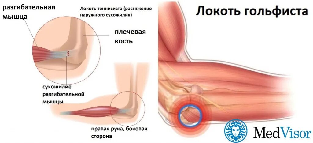 Локоть гольфиста эпикондилит. Локоть теннисиста эпикондилит. Локоть теннисиста и гольфиста. Воспаление сухожилий локтевого сустава.