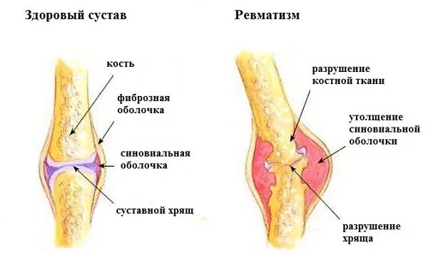 Ревматизм суставной формы. Суставная форма ревматизма симптомы. Ревматизм локтевого сустава. Симптомы суставного ревматизма. Изменение формы сустава