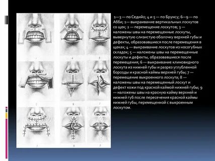 Операция нижней губы