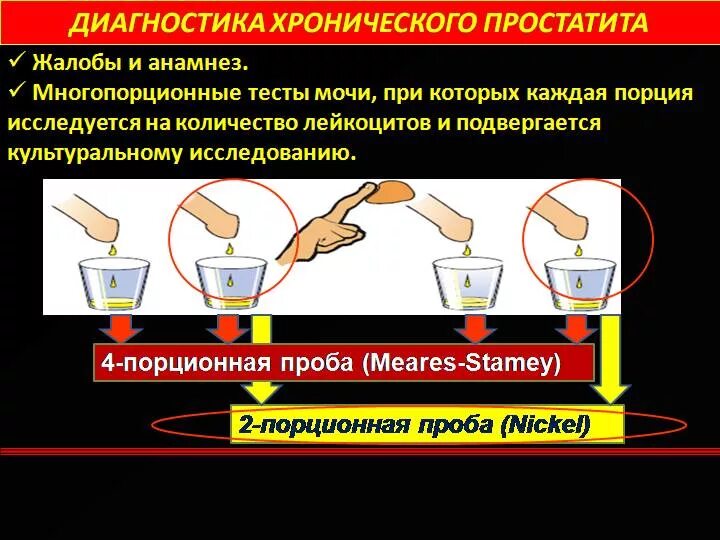 Видеоурок простата. Исследование сока предстательной железы. Взятие анализа секрета простаты. Сок простаты анализ. Лабораторная диагностика простатита.