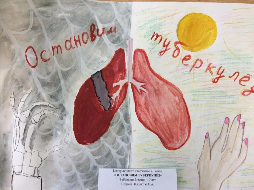 Туберкулез рисунок. Картинки на тему туберкулез. Плакаты по борьбе с туберкулезом. Рисунок против туберкулеза.