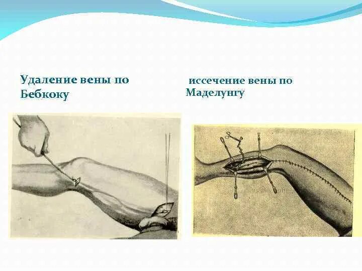 Удалить большую подкожную вену