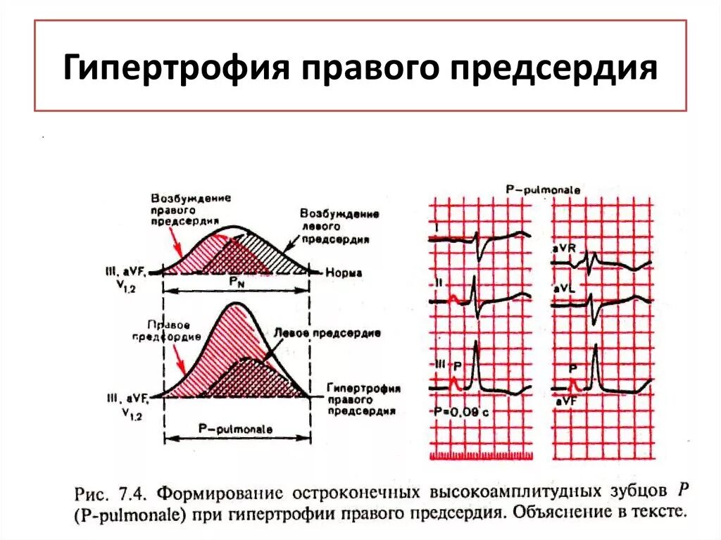 Признаки гипертрофии правого предсердия на ЭКГ. Гипертрофия левого предсердия на ЭКГ. Критерии гипертрофии правого предсердия на ЭКГ. Острая перегрузка правого предсердия на ЭКГ. Миокард левого предсердия