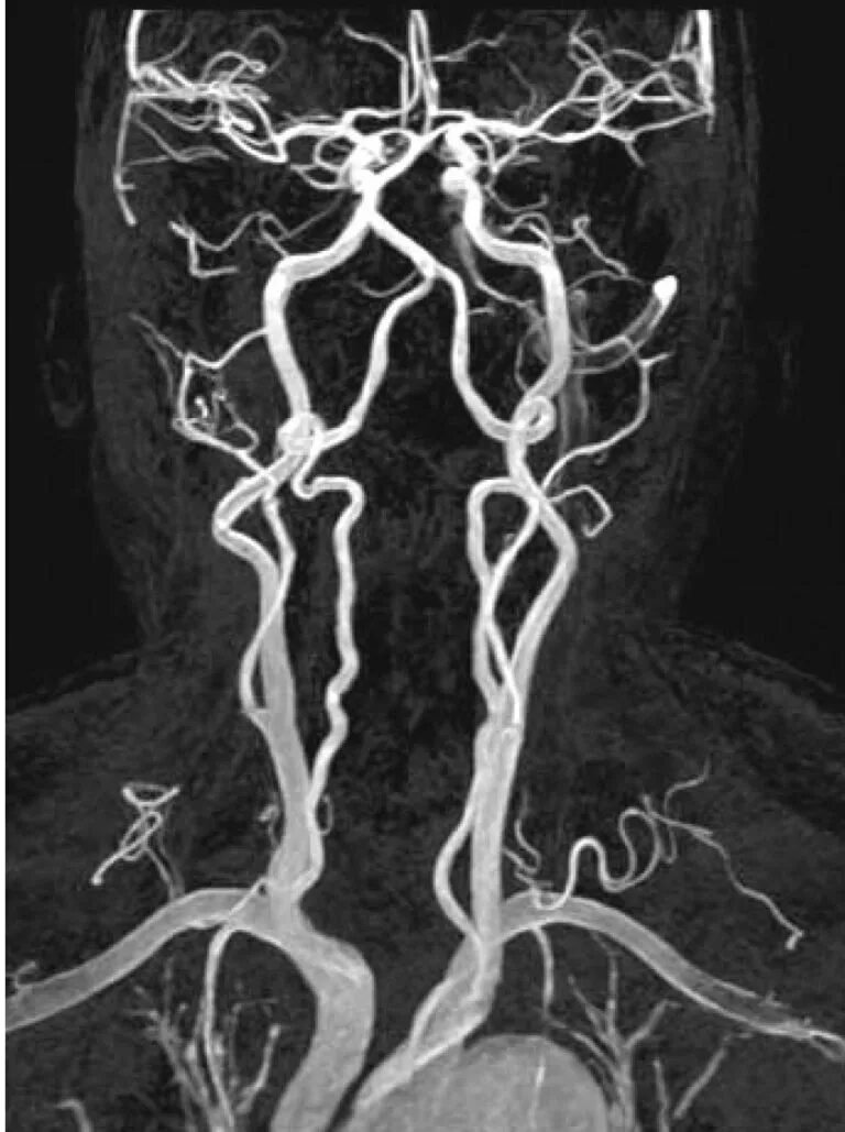 МР-ангиография артерий шеи. Кт ангиография сонных артерий. Кт ангиография брахиоцефальных артерий.