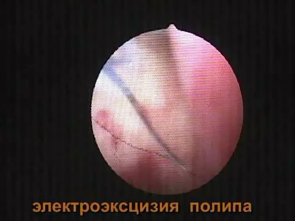 Как делают удаление полипа в матке. Полип эндометрия гистероскопия. электроэксцизия полипа. эндоскопическая электроинцизия. электроэксцизия полипа кишечника.