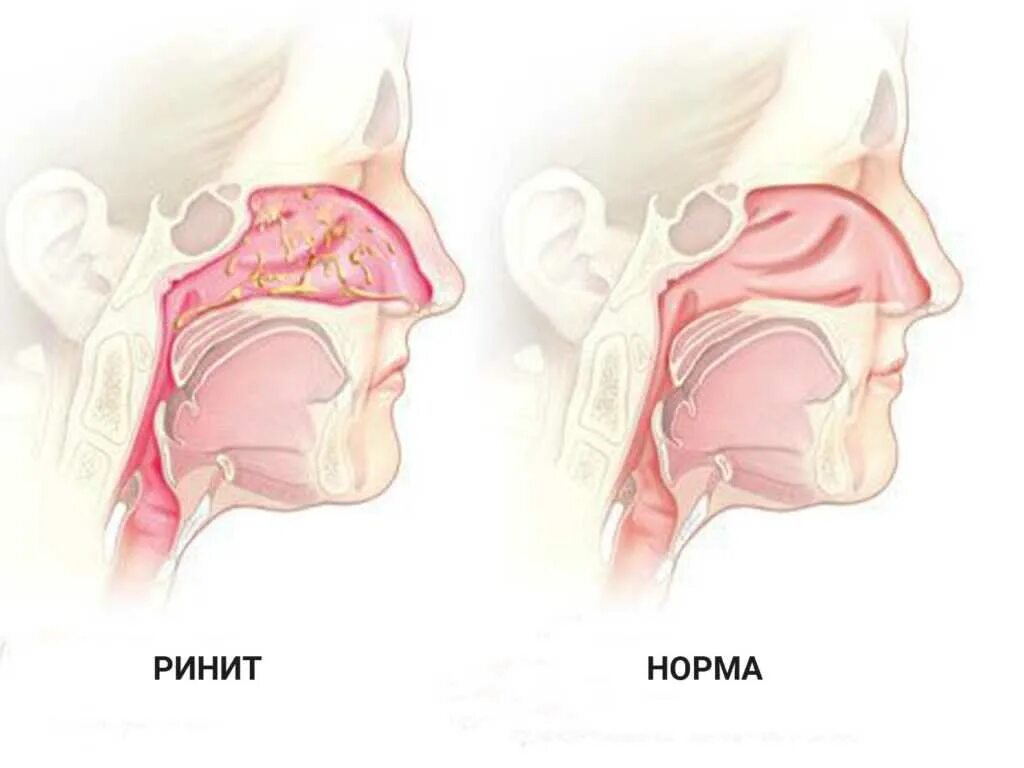 Вазомоторный ринит носовые раковины. Катаральный и гипертрофический ринит. Синусит и аллергический ринит. Хронический вазомоторный ринит. Почему носом без соплей