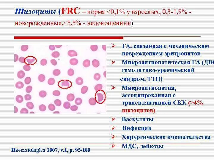 Анемия шизоциты. Мазок крови шизоциты. Эритроциты шизоциты. Подсчет шизоцитов в мазке крови.