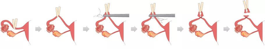 Как перевязывают трубы у женщин. Перевязка маточных труб. Лапароскопическая операция перевязка маточных труб. Перевязка труб лапароскопия лапароскопия маточных. Хирургическая стерилизация маточных труб.