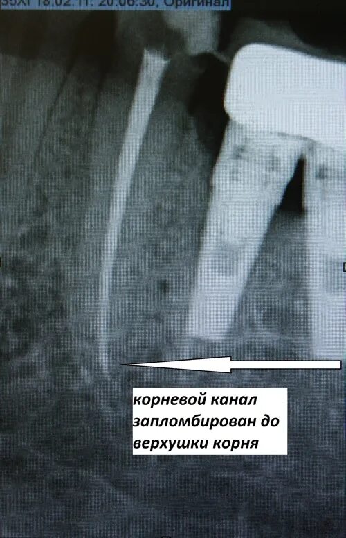 Не запломбировали каналы. Рентген снимок запломбированного канала зуба. Корневое канал запламбирован за верхушку. Как выглядит запломбированный канал на снимке.