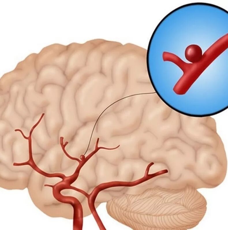 Артерии головного мозга симптомы. Аневризмы сосудов головного мозга. Аневризма головного мозга симптомы. Аневризма артерии головного мозга симптомы. Аневризм сосудов головного мозга симптомы.