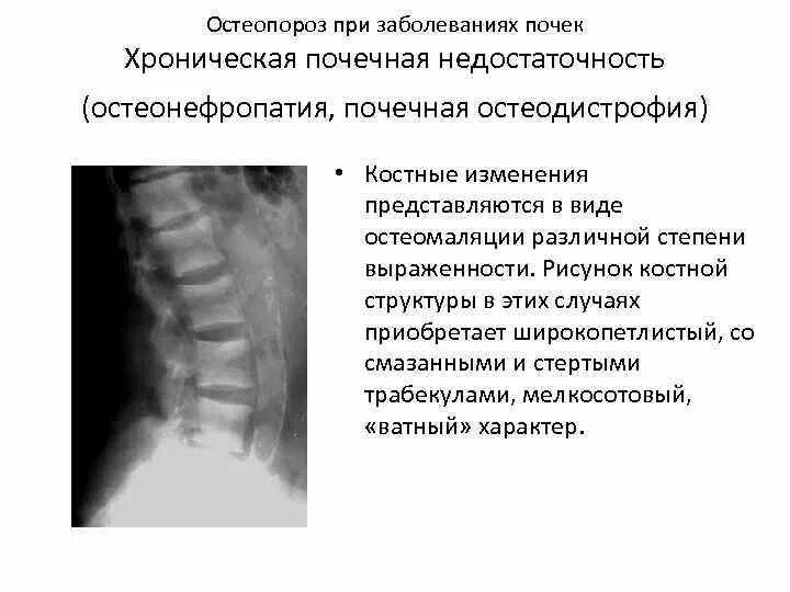 Остеопороз это заболевание. Ревматоидный артрит формулировка диагноза. Нарушение кальций фосфорного обмена. Остеопороз классификация. Синдром остеопороза.