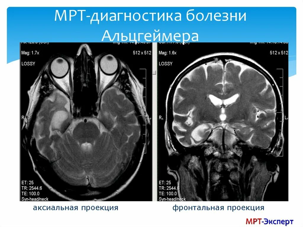 Диффузная атрофия головного мозга. Кт и мрт при болезни Альцгеймера. Мрт головного мозга при болезни Альцгеймера. Мрт в диагностике болезни Альцгеймера. Нейродегенеративные заболевания головного мозга мрт.