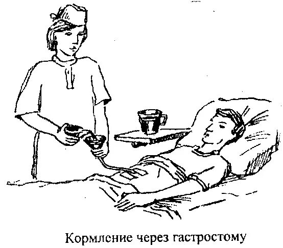 Алгоритм ухода за гастростомой в послеоперационном периоде. Кормление пациента через гастростому. кормление больного через гастростому алгоритм. кормление пациента через гастростому схема. кормление тяжелобольного пациента через гастростому.
