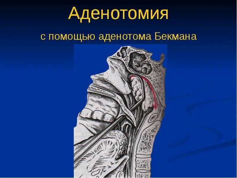 Аденотомия ход операции. Аденотомия м аденотонзиллотомия.