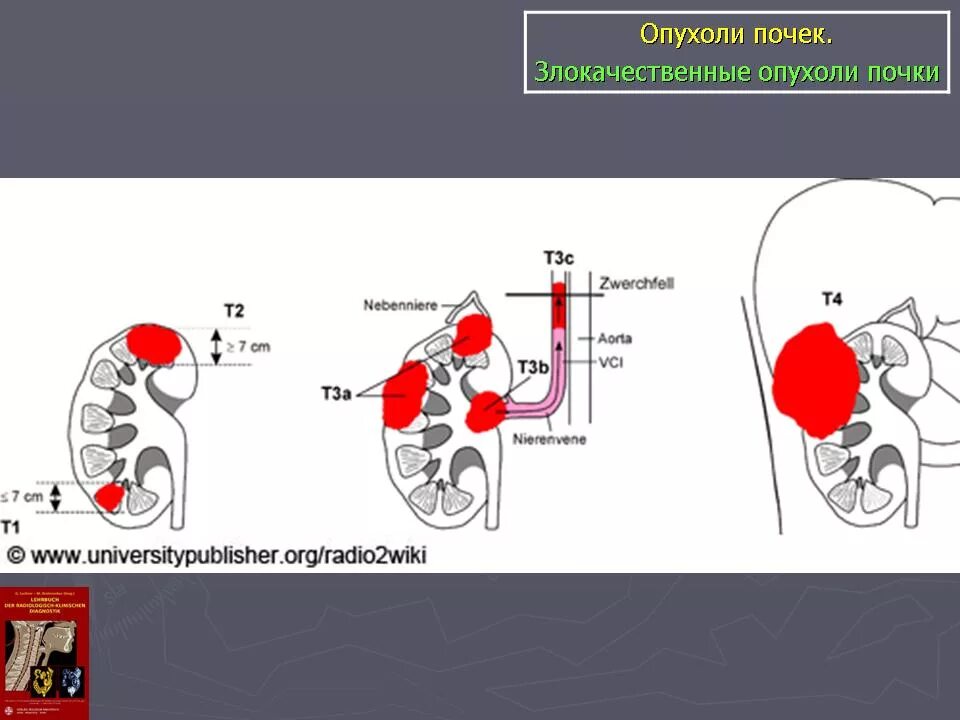 TNM классификация опухолей почек. Классификация почек онкология. Опухоль почки ТНМ. TNM почки классификация. 3 стадия рака почки