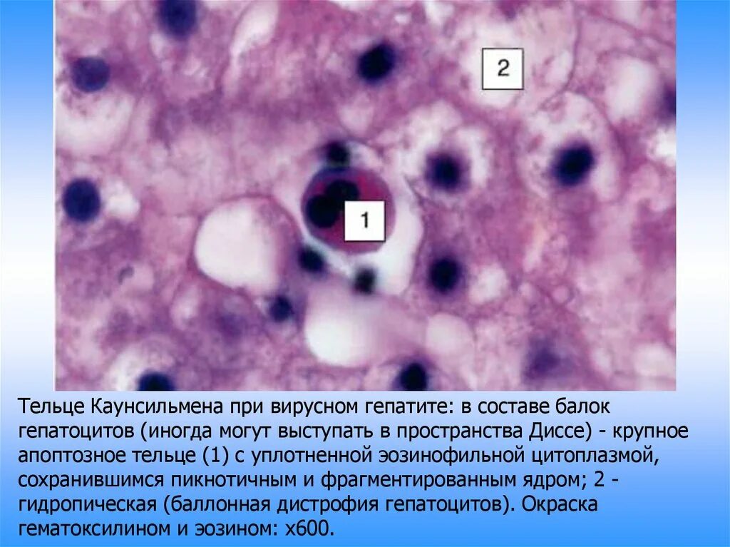 Многочисленные мелкие тельца. Апоптозные тельца каунсильмена. Тельца каунсильмена патологическая. Тельца каунсильмена печень.