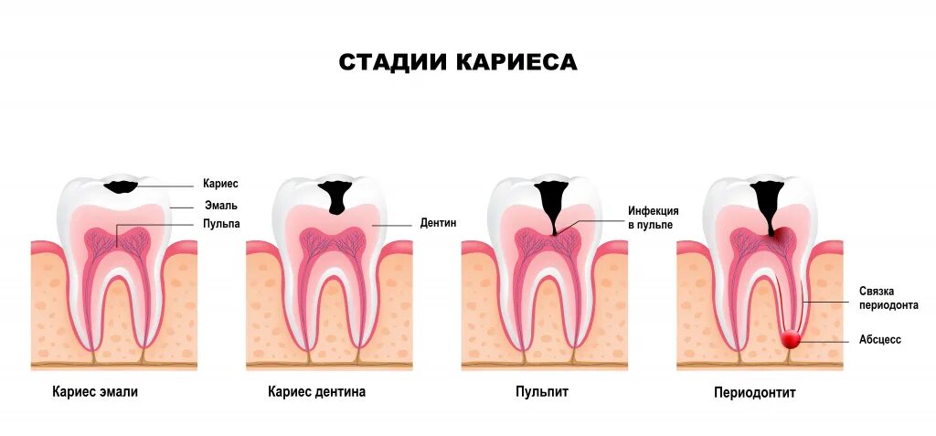 Кариес передается от человека к человеку. Кариес эмали (поверхностный кариес) патанатомия. кариес эмали; кариес дентина; кариес цемента. стадии образования кариеса.