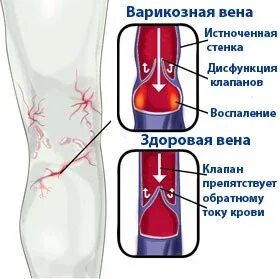 Тромб уменьшающий просвет сосуда