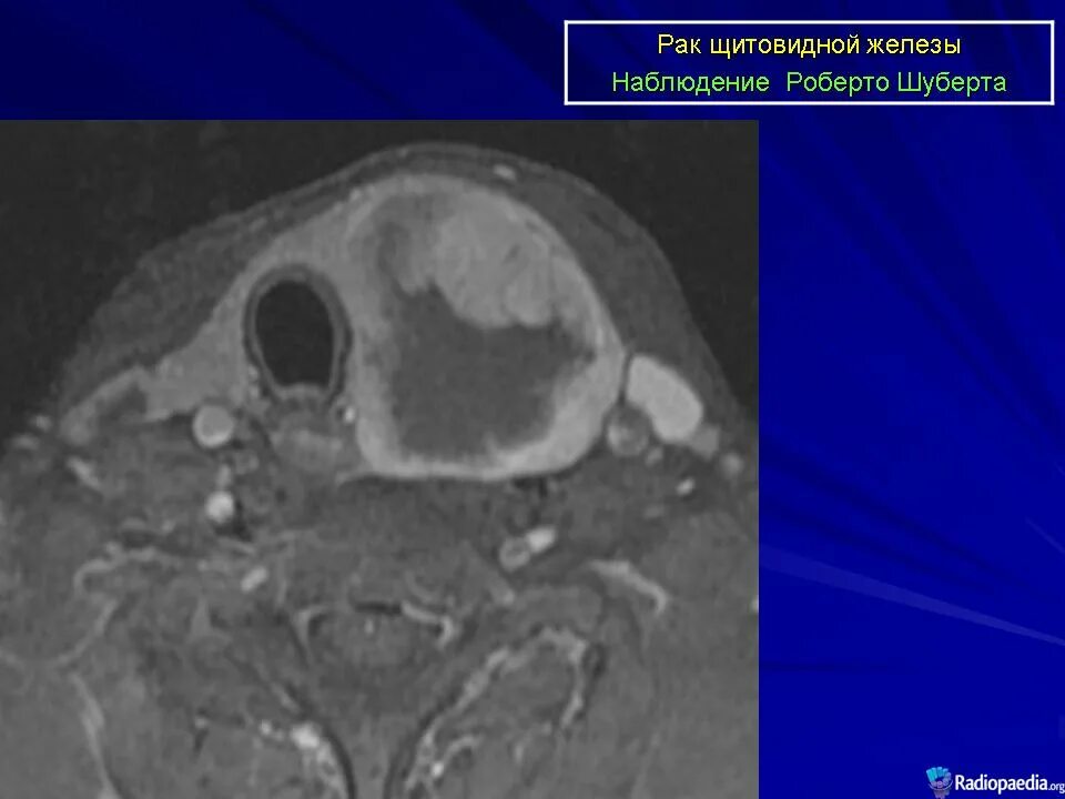 Метастазы при раке щитовидной железы. Фолликулярная аденома щитовидной железы кт. Карцинома щитовидной железы на кт. Кистозная карцинома щитовидной железы кт. Гиперплазия щитовидной железы кт.
