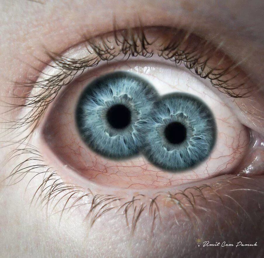 Поликория аномалия глаз. Глаз с несколькими зрачками.