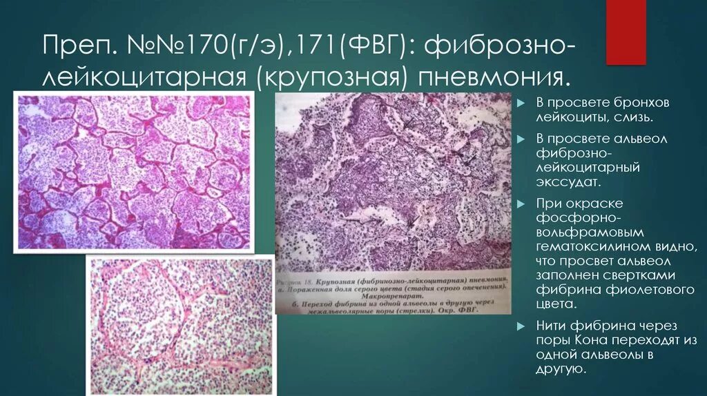 Ишемический инфаркт почки микропрепарат патанатомия. Хроническая застойная гиперемия печени микропрепарат. Венозная гиперемия печени макропрепарат. Мускатная печень препарат патанатомия. Антракоз легких гистология.