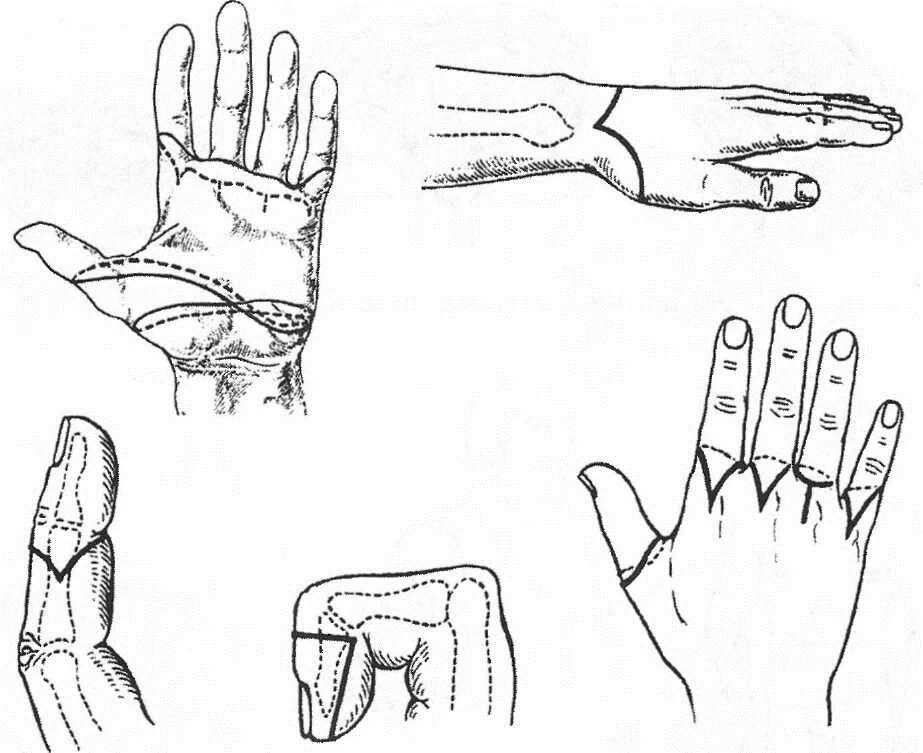 Вычленение кисти в лучезапястном суставе. Ампутация дистальной фаланги пальца. Экзартикуляция пальца по люппи. Экзартикуляция фаланг пальцев. Экзартикуляция 1 пальца кисти по мальгеню.
