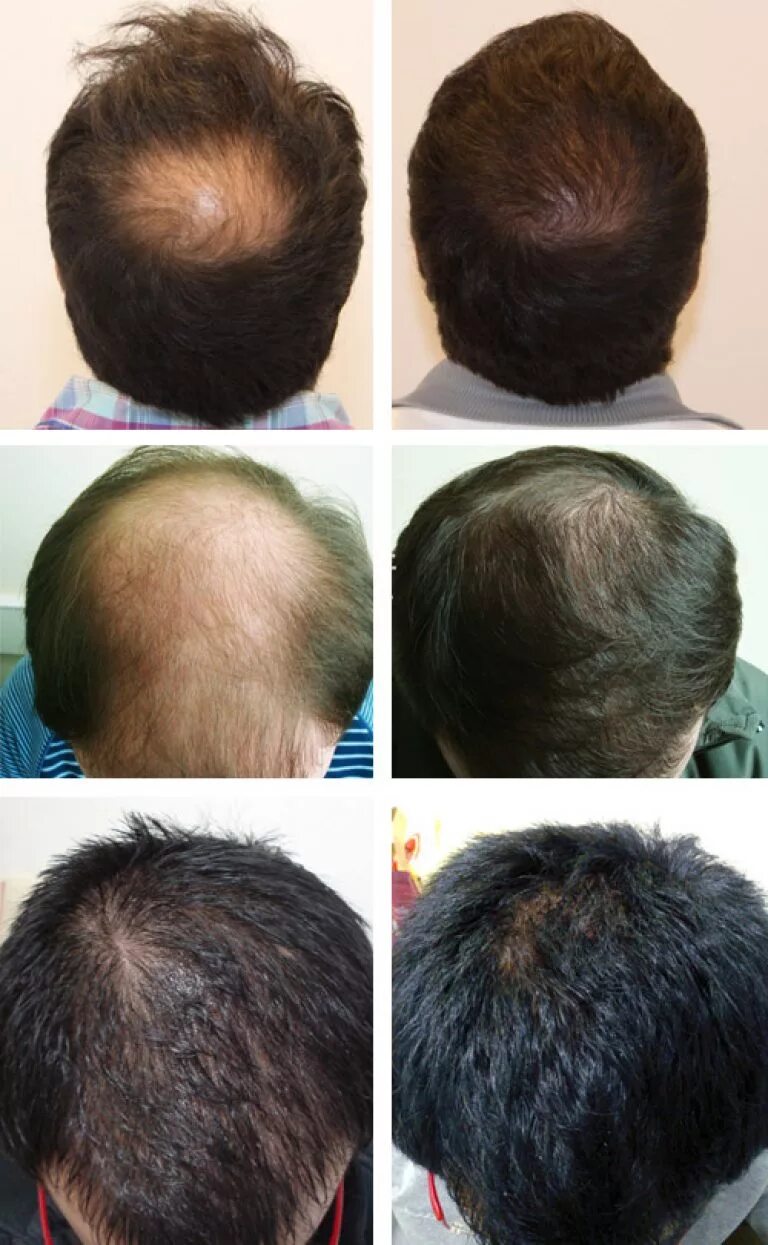 Восстановление выпадения волос. Андрогенная алопеция алопеция. Андрогенная алопеция миноксидил. Андрогенетическая алопеция у мужчин.