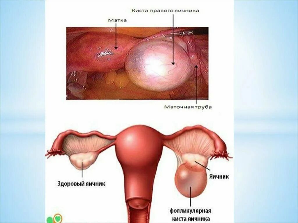 Фолликулярная киста яичника. Фолликулярная киста яичн. Фолликулярная киста правого яичника. Фолликулярная киста киста яичника это.