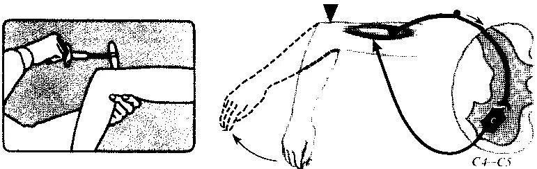 Рефлекторная дуга верхних конечностей. Локтевой сгибательный рефлекс физиология. Рефлекторная дуга верхних конечностей. Разгибательный локтевой рефлекс. Рефлекторная дуга верхних конечностей.