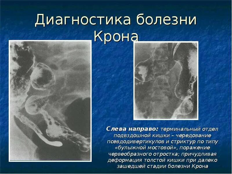Гистологическая картина болезни крона. Поры крона. Альвеолярные поры кона. Легочные альвеолы гистология. Болезнь крона толстой кишки.