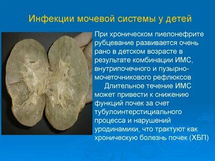 Мочевыделительные заболевания у детей