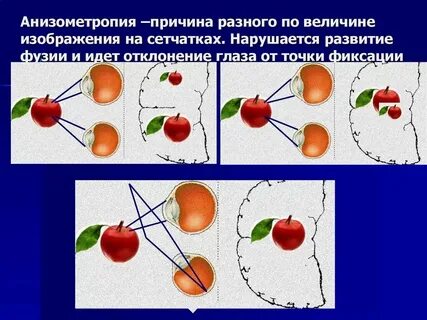 Анизометропией коррекция