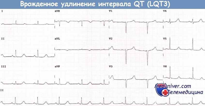 Удлинение интервала qt. Удлинение интервала qt