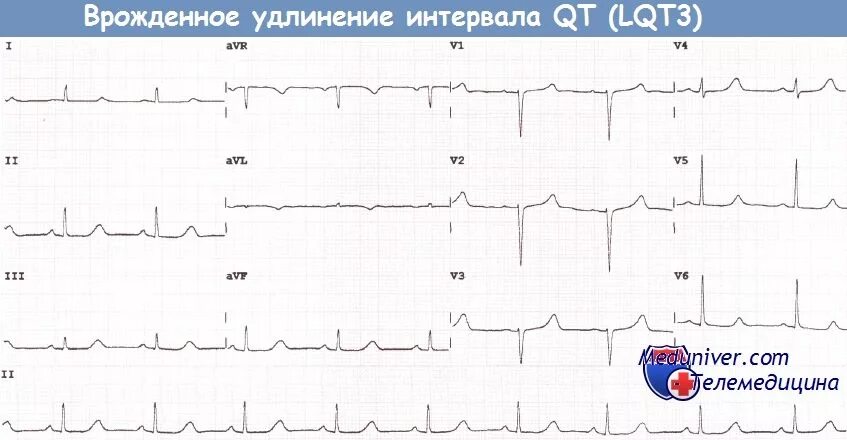 Удлиненное qt у ребенка. Синдром удлиненного интервала qt на ЭКГ. Удлиненный интервал qt на ЭКГ что это такое. Удлинённый qt на ЭКГ. ЭКГ С синдромом удлиненного интервала qt у детей.