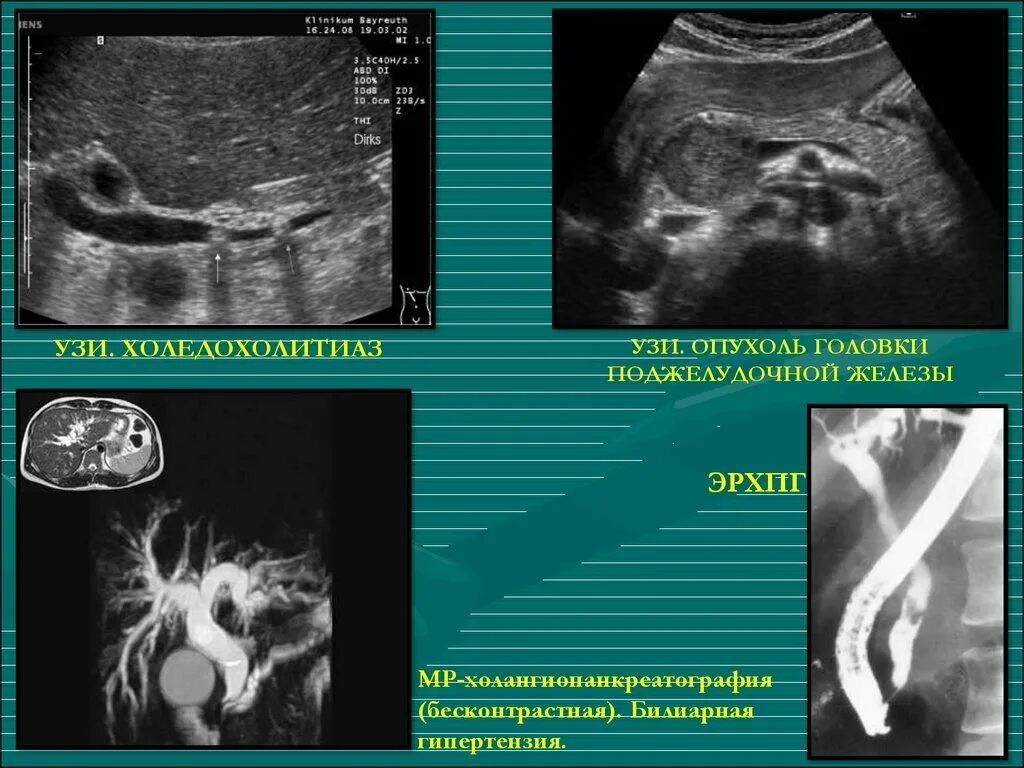 Билиарная гипертензия это. Желчекаменная болезнь ЭРХПГ. Хронический калькулезный холецистит УЗИ. Холедохолитиаз на УЗИ.