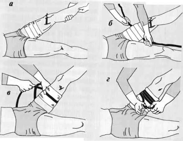 Бедренная перевязка. Наложение жгута при повреждении бедренной артерии. Алгоритм наложение резинового кровоостанавливающего жгута на бедро. Наложение жгута при ранении бедренной артерии. Артериальное кровотечение наложение жгута.