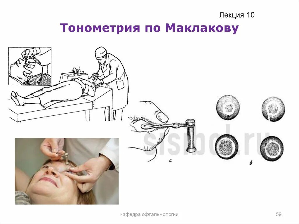 Определение внутриглазного давления по маклакову. Тонометр внутриглазного давления по маклакову. измерение внутриглазного давления по маклакову. алгоритм измерения вгд тонометром маклакова. тонометрия вгд по маклакову.