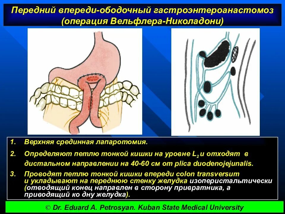 Гастроэнтероанастомоз. Позадиободочная гастроэнтеростомия. Впередиободочный гастроэнтероанастомоз. Гастроэнтеростомия это операция. Анастомозит что это