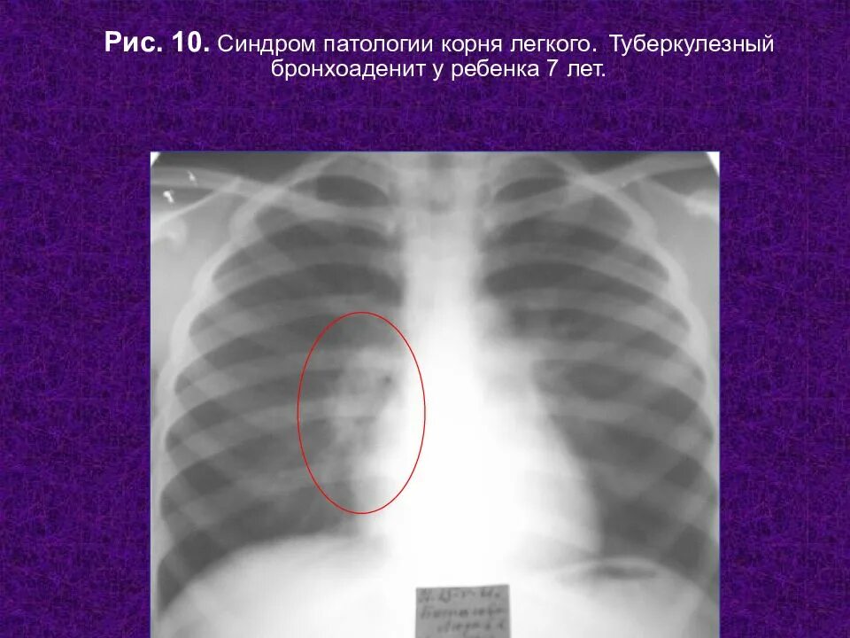 Патология корня легкого рентген. Синдром патологии корня лёгкого. Корень легкого на рентгенограмме. Легочные корни расширены