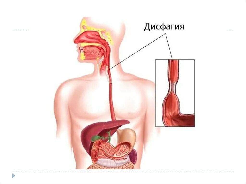 Пищевод проходим. Дисфагия 3. Пищеводная дисфагия причины.