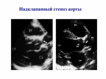 Впс2 чи