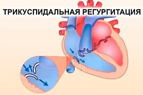 Легочная артерия и трикуспидальная регургитация