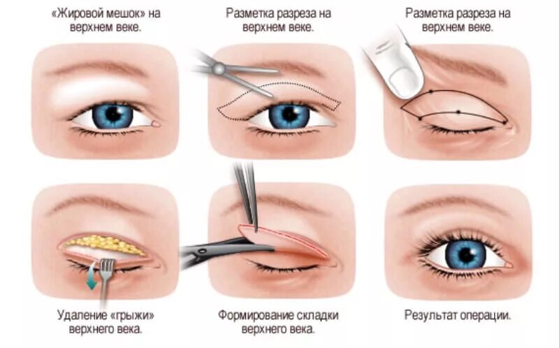 Удалить веки