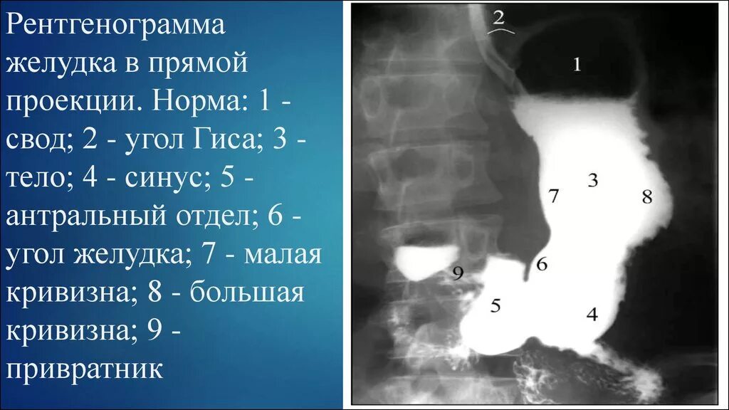 Рентген анатомия желудка в норме. Рентгенограмма желудка в прямой проекции. Отделы желудка на рентгенограмме. Скопия пищевода желудка