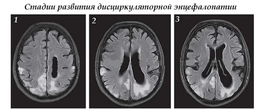 Дисциркуляторная энцефалопатия мрт. Дисциркуляторная энцефалопатия головного мозга на кт. Гипертензивная энцефалопатия мрт. Дисметаболическая энцефалопатия мрт. Хтэ болезнь