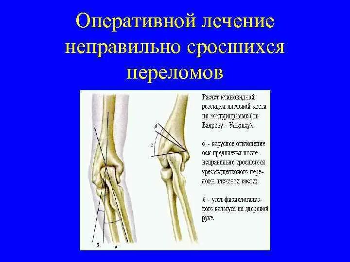 Переломы травматология. Неправильно сросшийся перелом. Неправильно сросшийся перелом руки. Неправильное сращение перелома.
