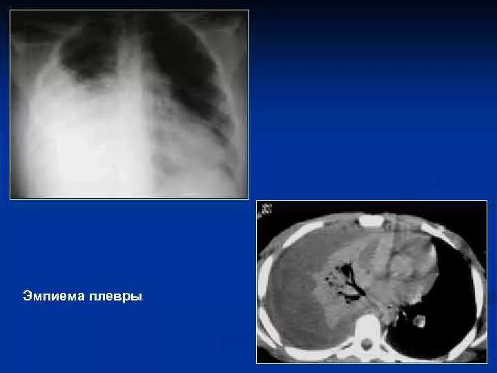 Эмпиема легкого. Эмпиема плевры, пиоторакс.. Хроническая эмпиема плевры рентген. Эмпиема легкого рентген. Тотальная эмпиема плевры рентген.